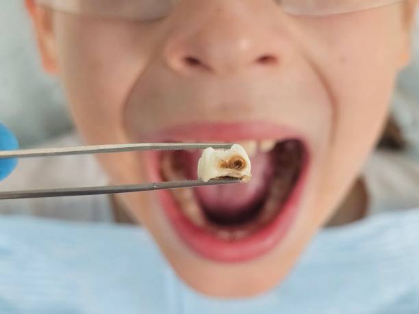 Best Tooth Infection Emergency Dentist  in Lauderdale, MN